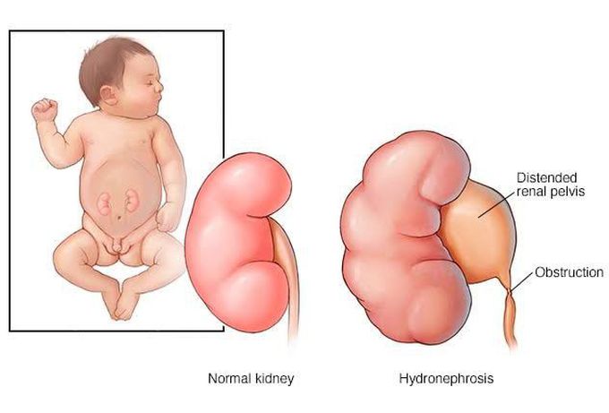 Hydronephrosis