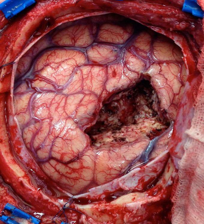 CEREBRAL AVM (AVM-Arteriovenous malformation Arteriovenous malformation)