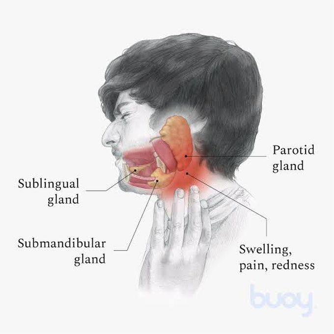 Swollen Salivary Glands Under Chin 1388