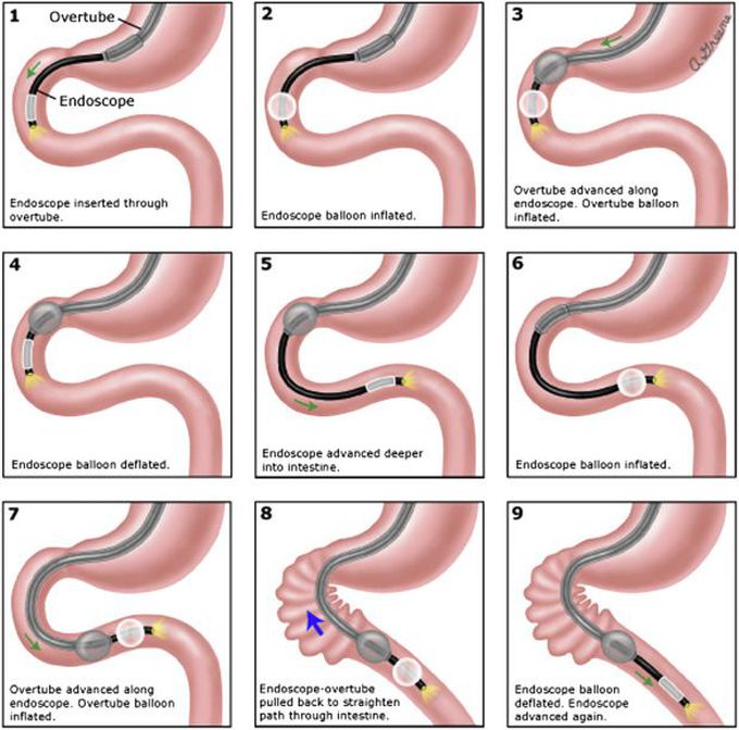 Double-Balloon Enteroscopy