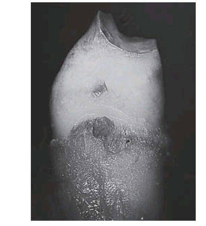 Amelogenesis imperfecta