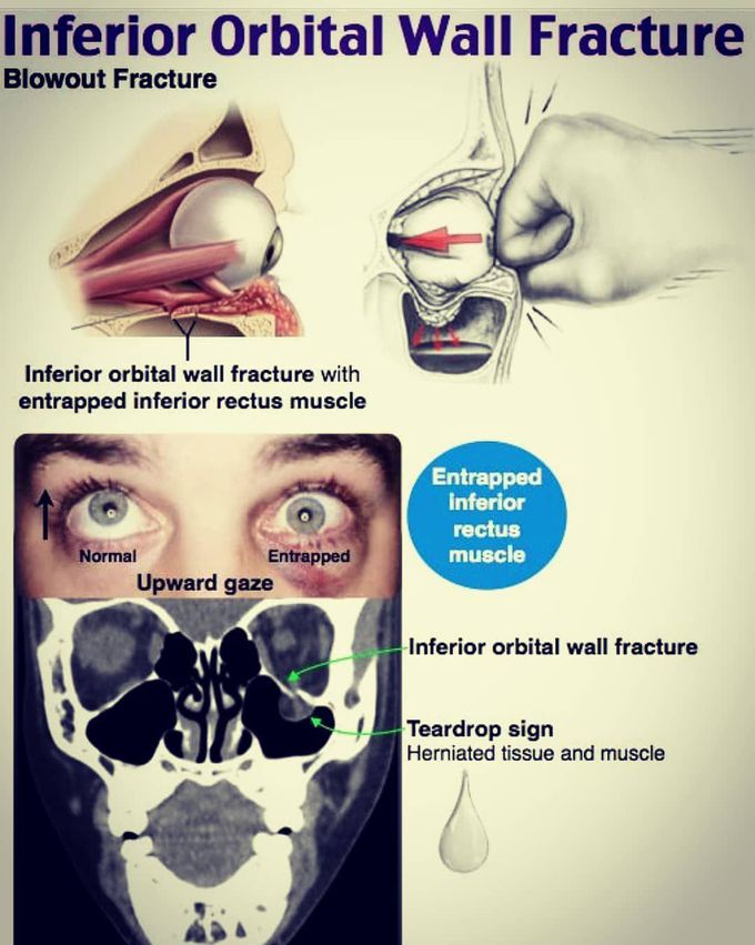 Inferior orbital wall fracture