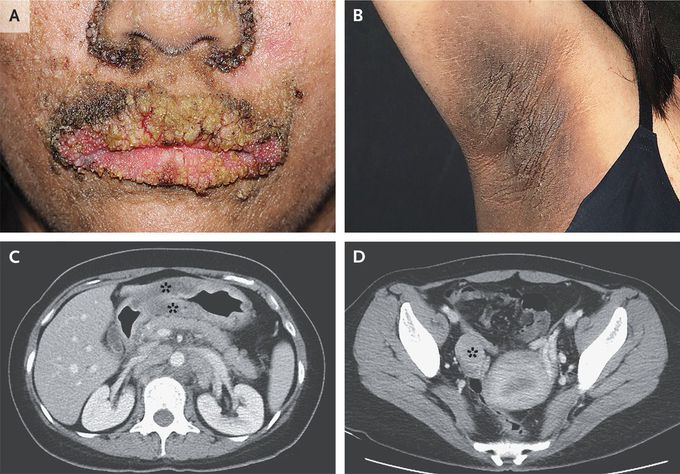 Malignant Acanthosis Nigricans