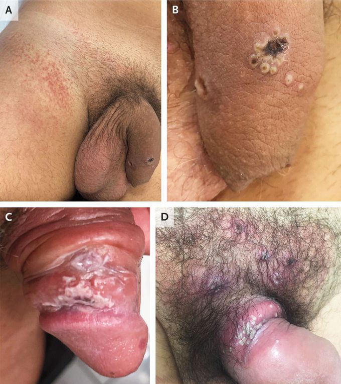 Monkeypox Genital Lesions