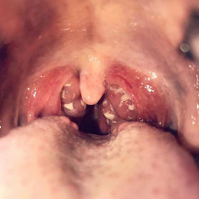 Pharengitis