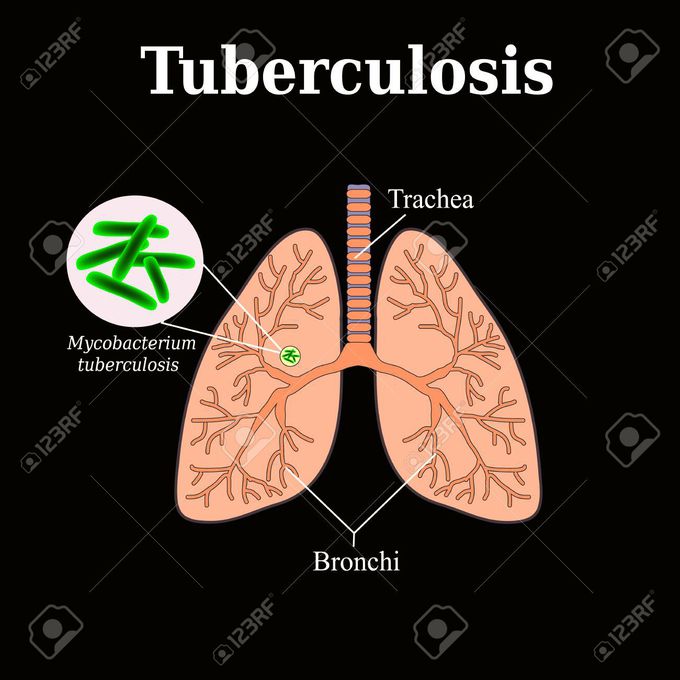 Tuberculosis