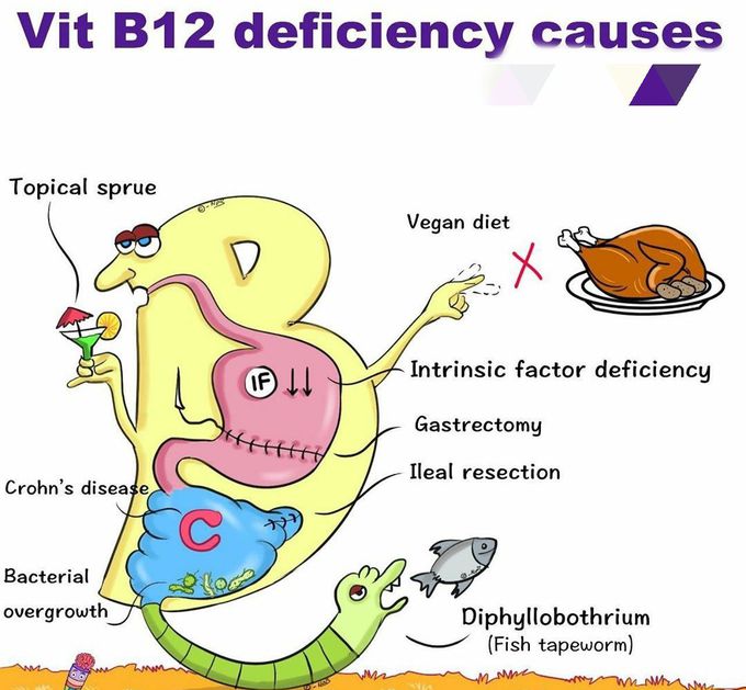 Vitamin 12 deficiency