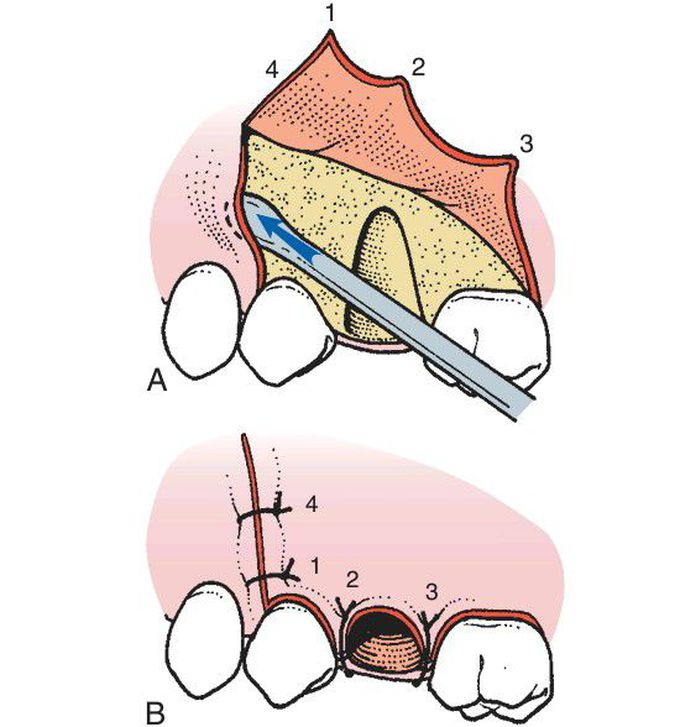 Suturing of flap