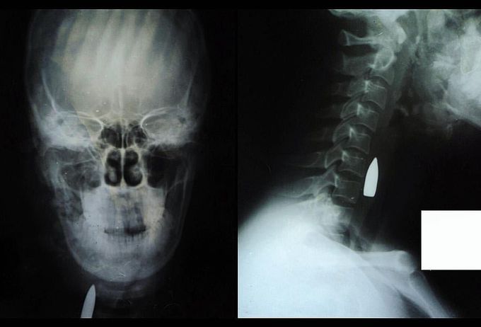 Bullet lodged in the neck!!
