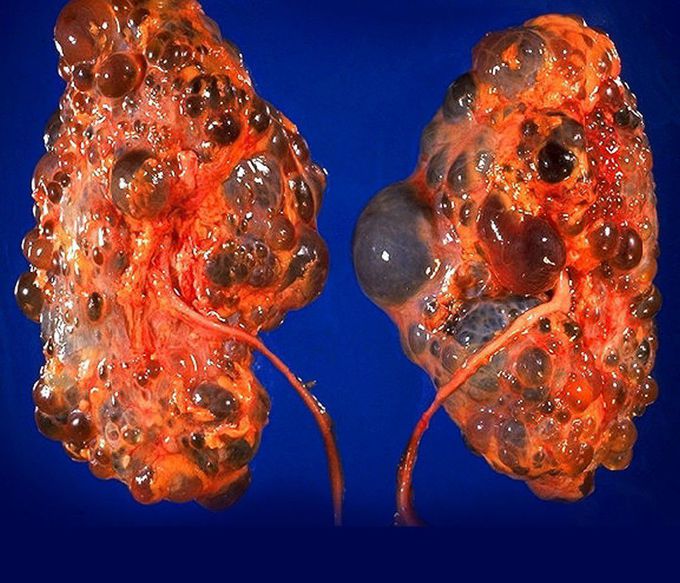 Autosomal Dominant Polycystic Kidney Disease