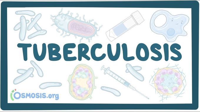 Tuberculosis - causes, symptoms, diagnosis, treatment, pathology