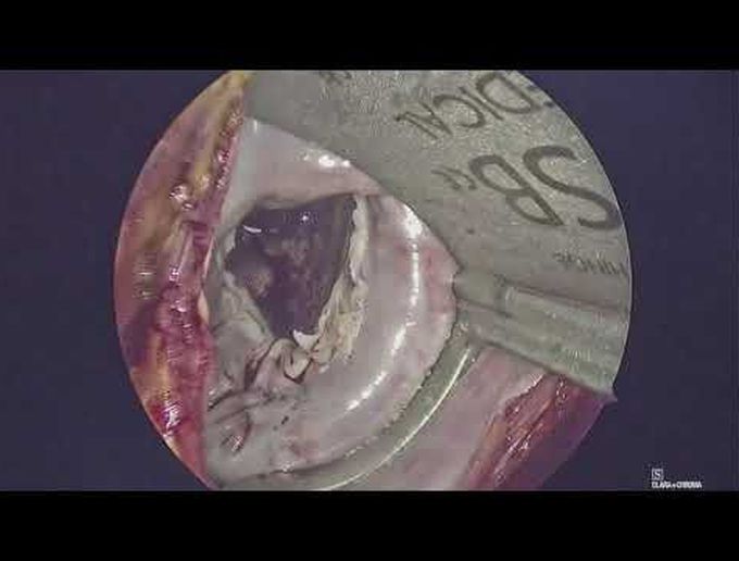 Emergent/Salvage Minimally Invasive Mitral Valve Replacement