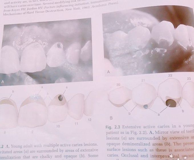 Dental caries