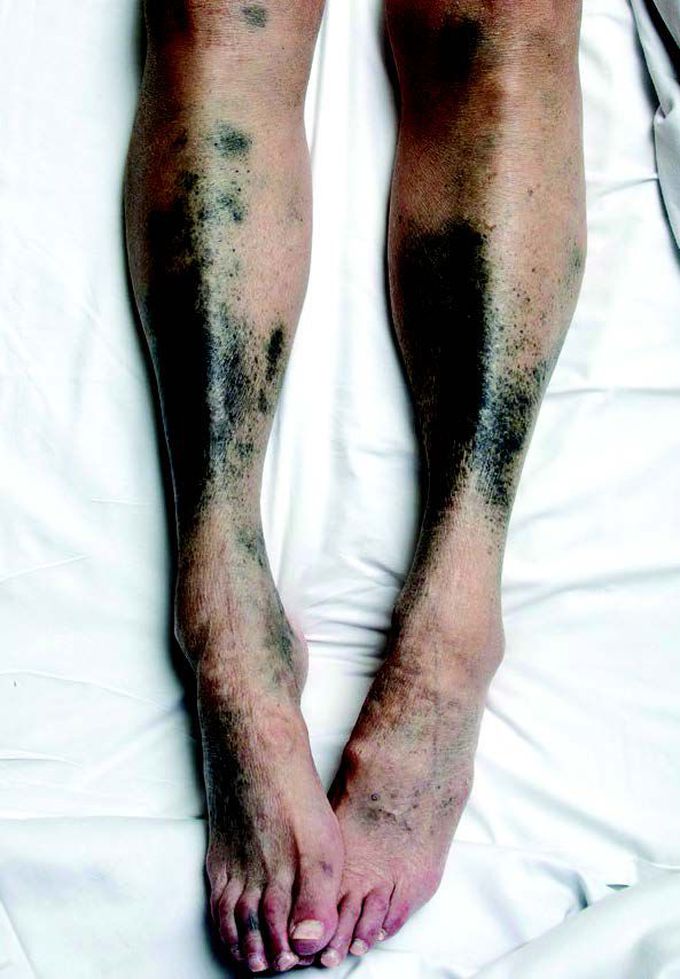 Blue–black eyes and legs