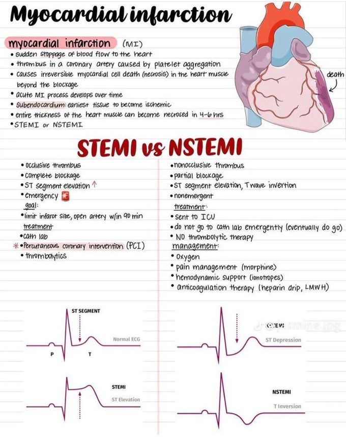 Myocardial infarction