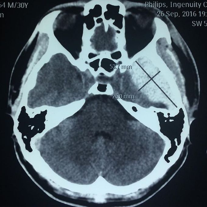 An epidural hematoma on left parietobasal region... 