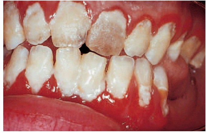 Gingivitis