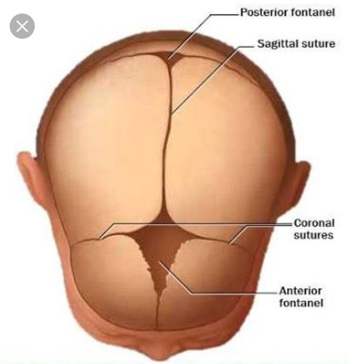 Craniosynostosis