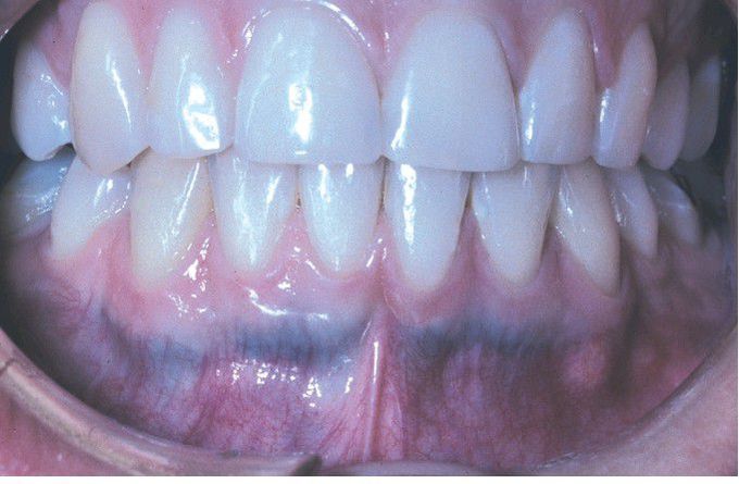 Minocycline-related Discoloration