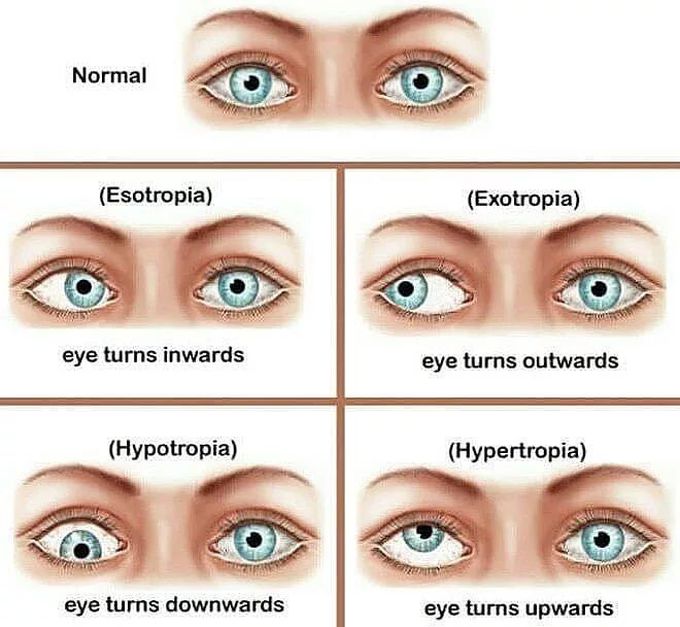 Pathological Eye Alignments