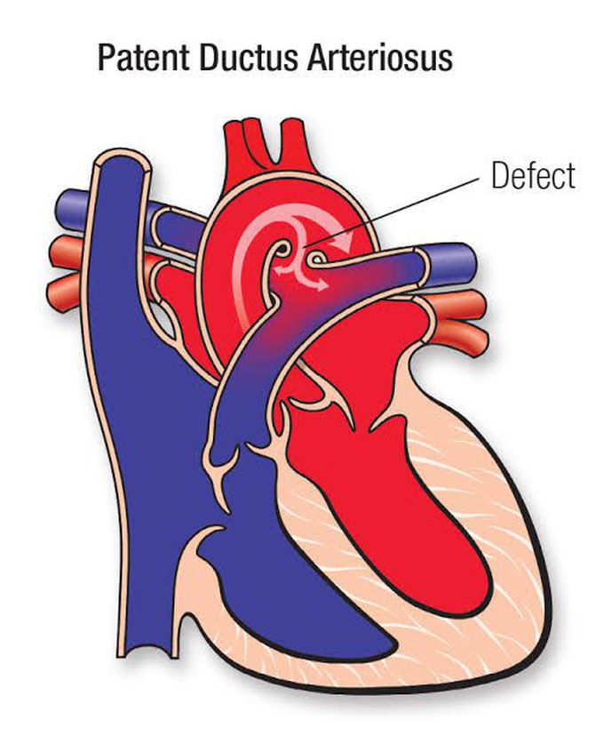 Patent ductus arteriosus - MEDizzy