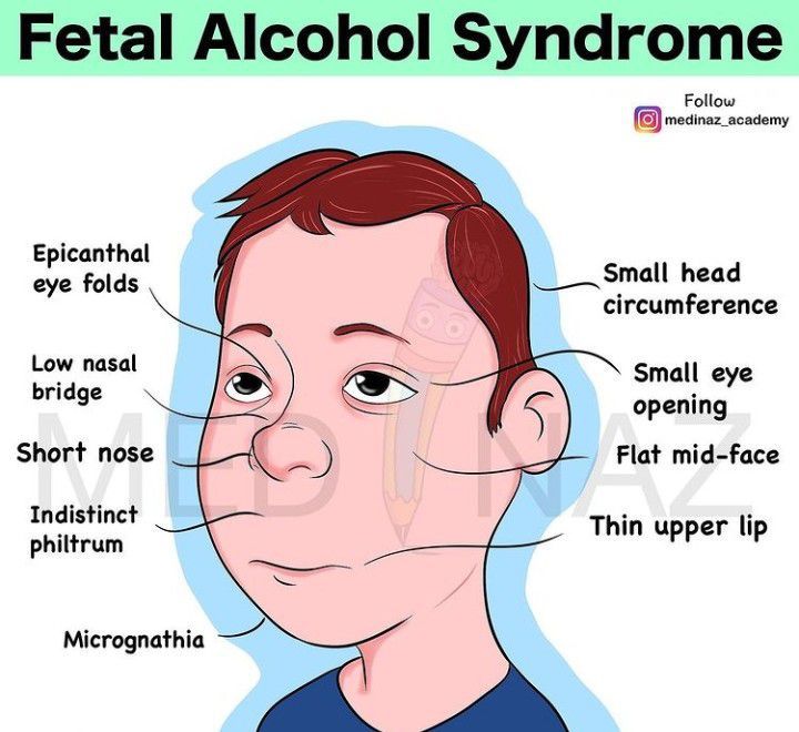 Fetal alcohol syndrome - MEDizzy