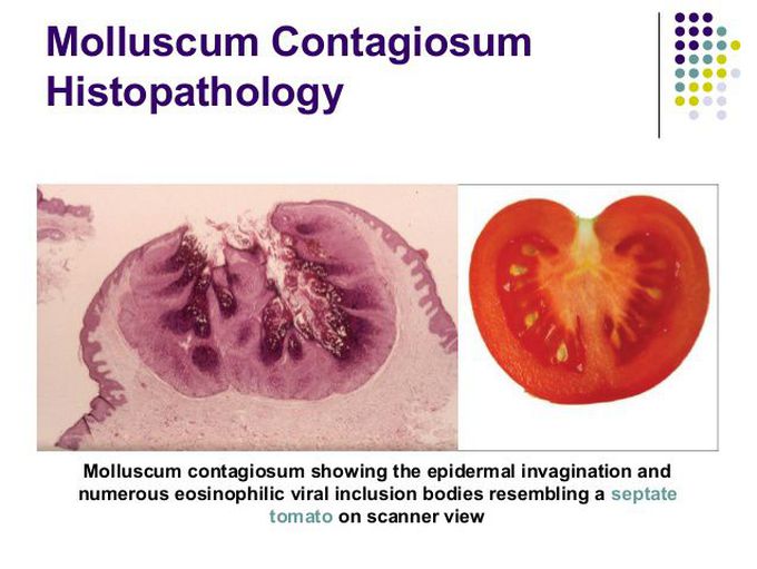 molluscum contagiosum
