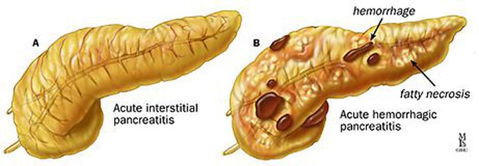 Diagnostic Criteria for Acute Pancreatitis