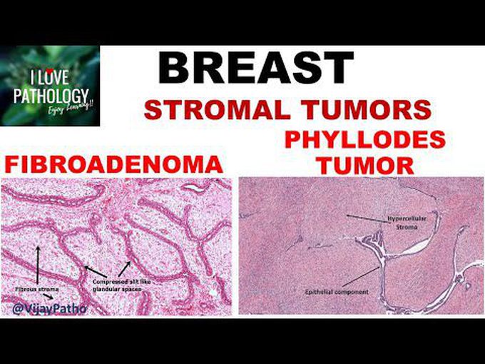 Breast pathologies Part 3