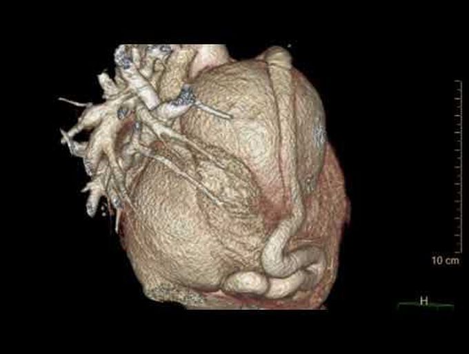 Surgical Management of a Giant Right Coronary Artery Aneurysm