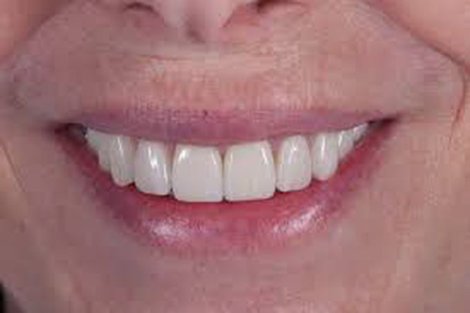 Disadvantages of poreclain veneers