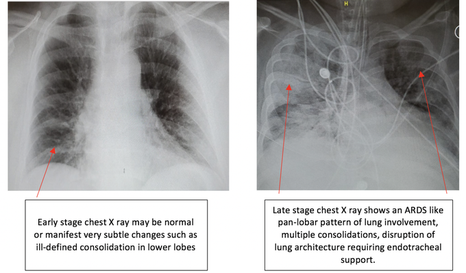 Chest x-ray findings in early and late stages of Covid-19