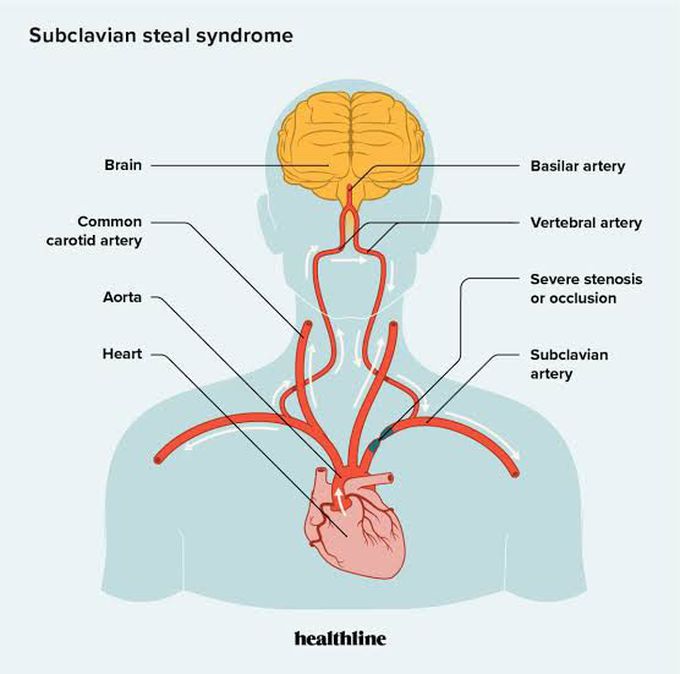 Subclavian Steal Syndrome