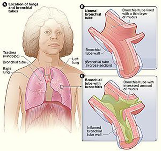Bronchiolitis