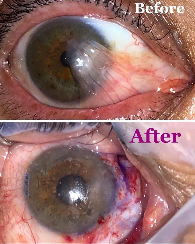 Pterygium growing onto the cornea! 