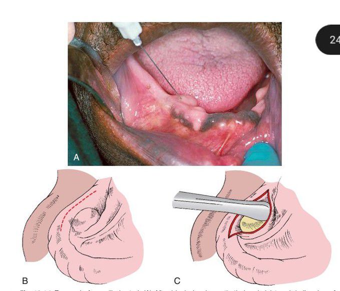 Removal of mandibular tori