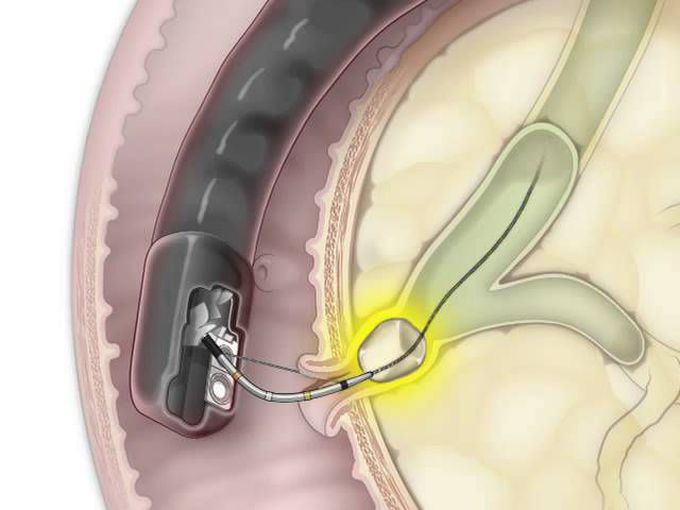 ERCP | Removal of a Stone in the Bile Duct