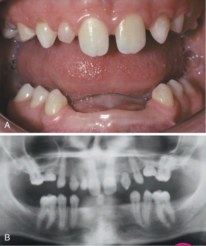 Hypodontia