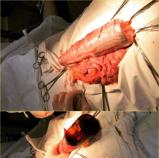 "Accidental discovery during surgery" 🤐
