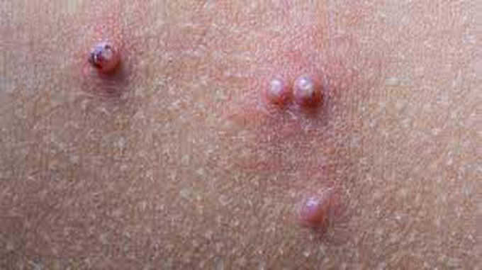 How is molluscum contagiosum treated?