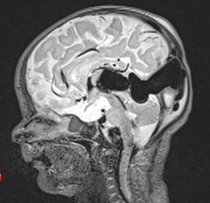 The vein of Galen aneurismal malformations