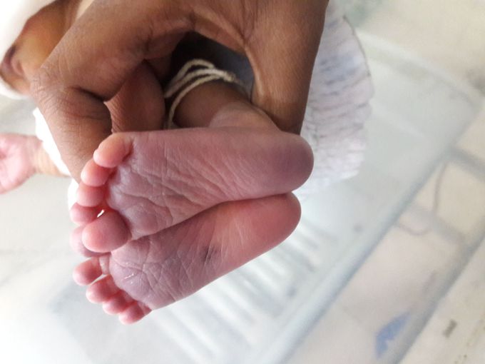 Cyanosed.....foot of an infant