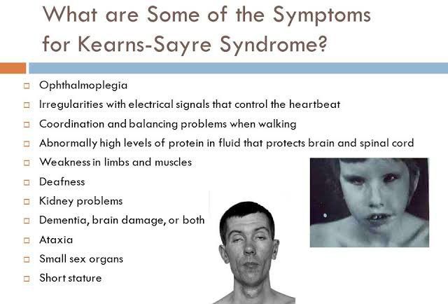 How To Say Kearns Sayre Syndrome