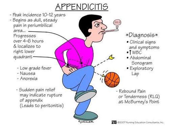 Appendicitis