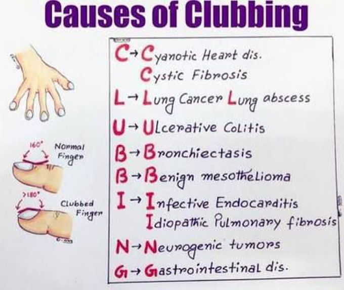 Causes of clubbing.