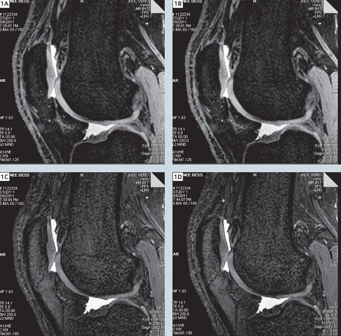 Sagittal water selective 3D DESS imaging of the knee