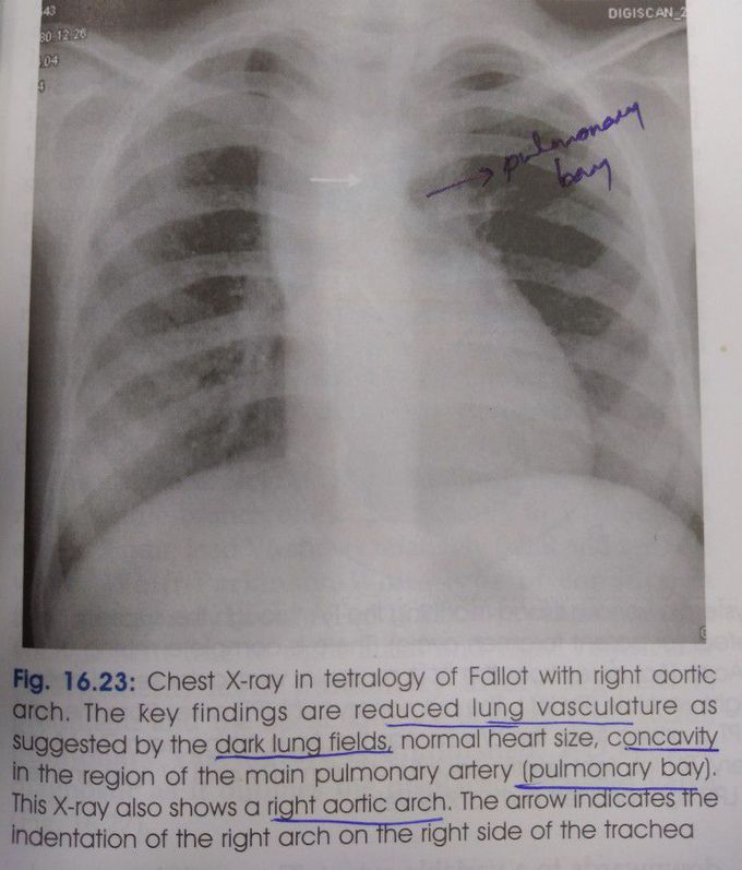 Tetralogy of Fallot