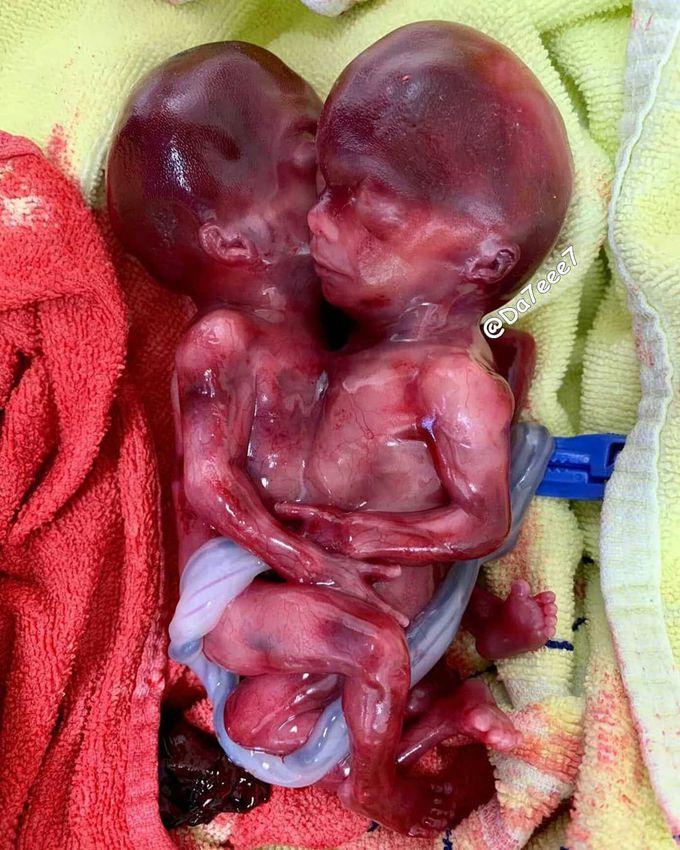 Thoracopagus conjoined twins
