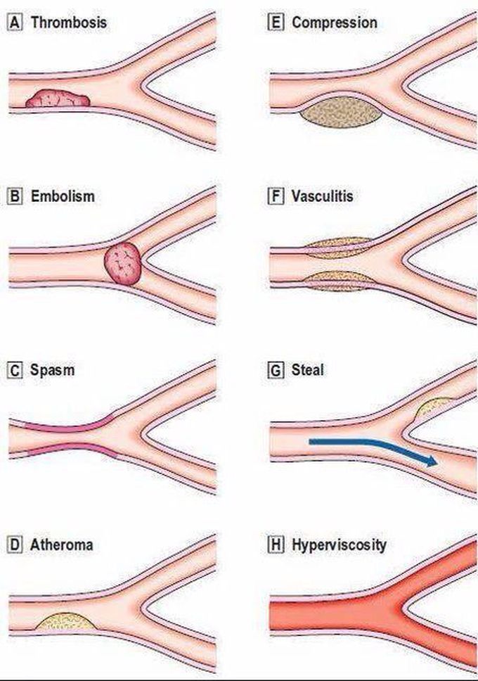 Types of Arterial Occlusion