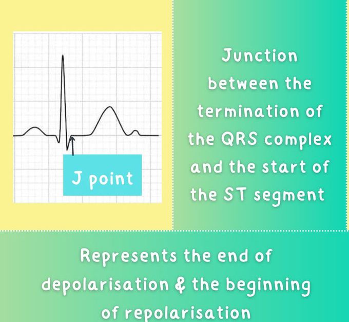 J Point on ECG I